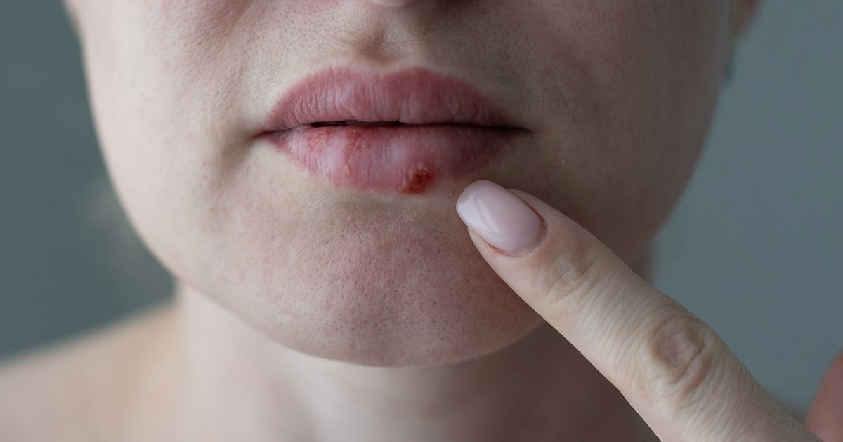 Pritelivir: el antiviral que la FDA aprobó para destrabar el herpes que no se va