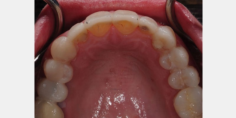 Carillas dentales: la filtración puede comenzar en un borde casi imperceptible